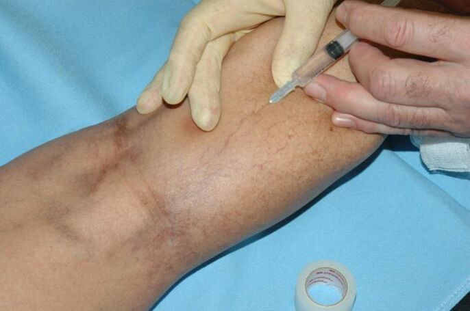 skleroterapia