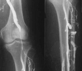 Možnosti diagnostiky kŕčových žíl končatín