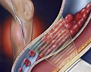 kŕčové žily hlbokých žíl dolných končatín